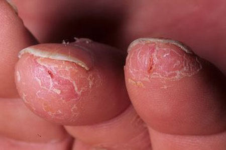 От чего сухая кожа на суставах пальцев рук