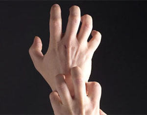 Участки сухой кожи на пальцах рук