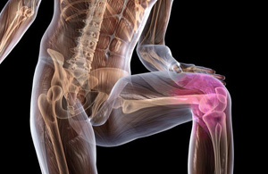Остеоартроз коленного сустава лечение